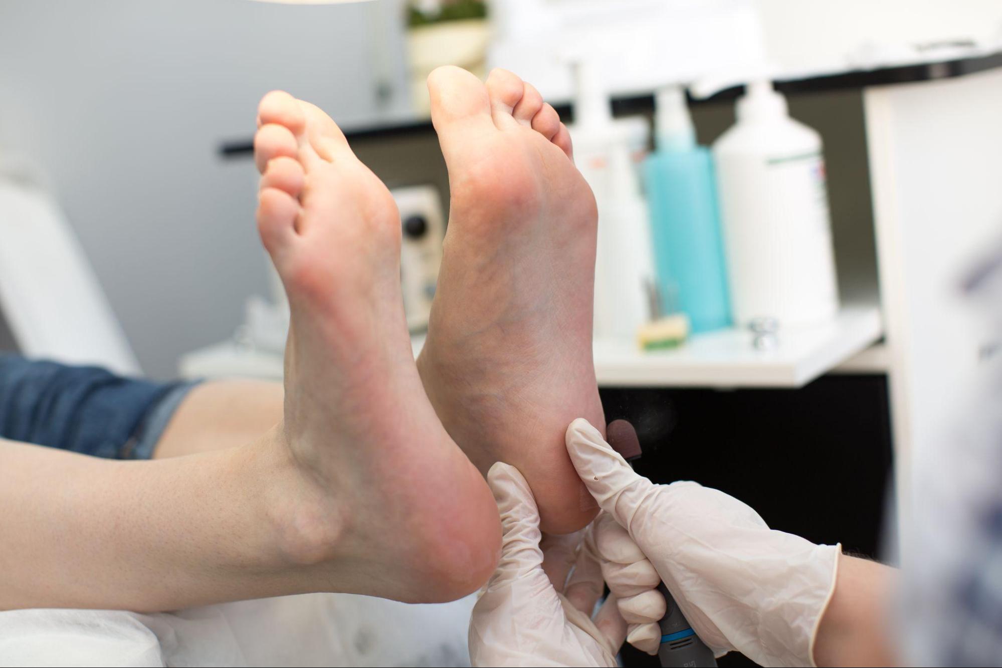 high arch foot treatment in singapore
