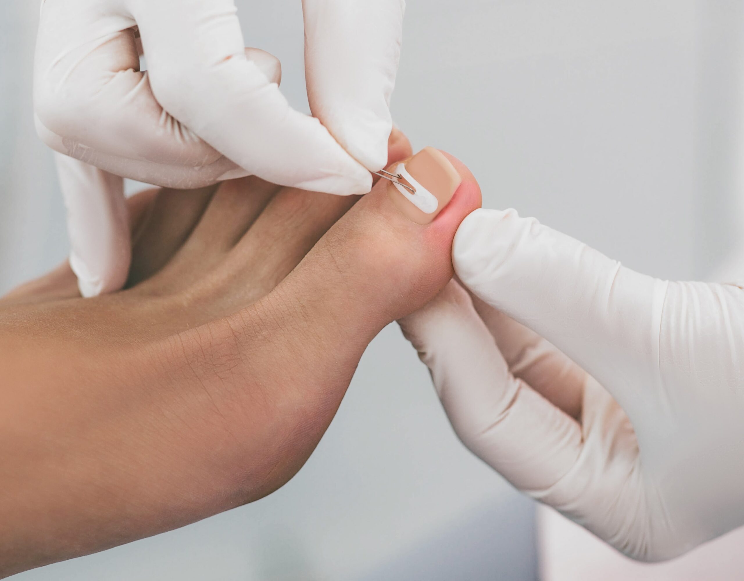 ingrown toenail treatment singapore