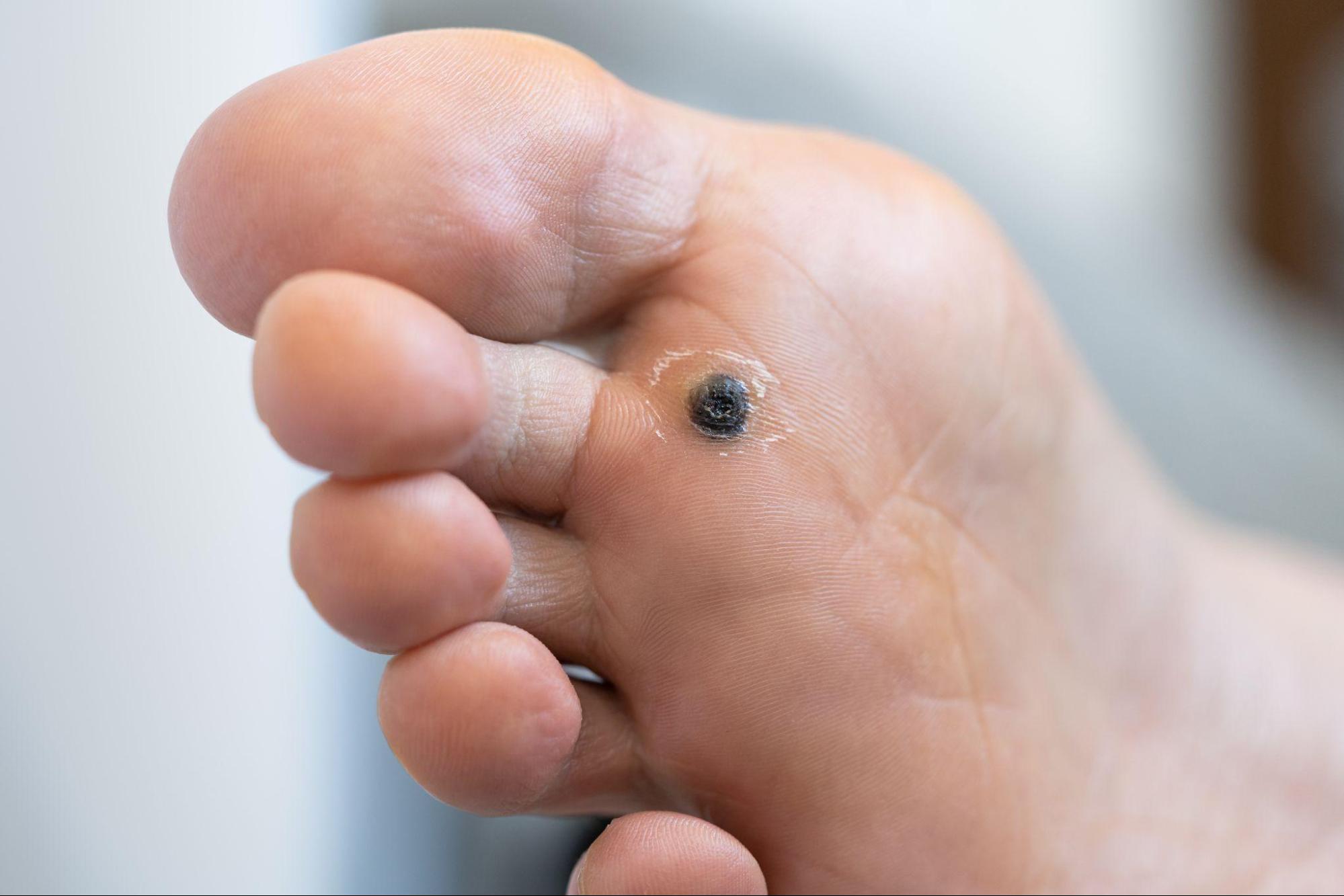 why professional foot wart removal is important