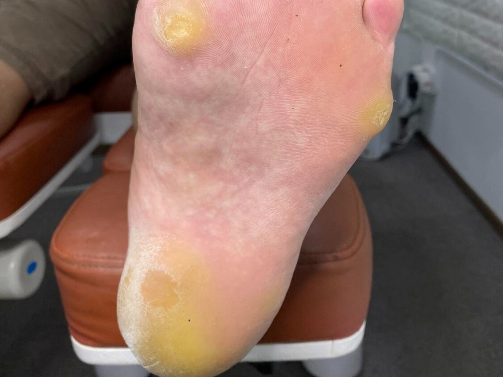 how corns and calluses form 3
