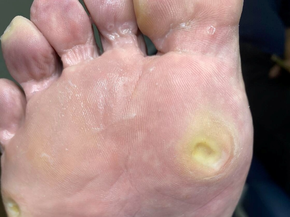 how corns and calluses form