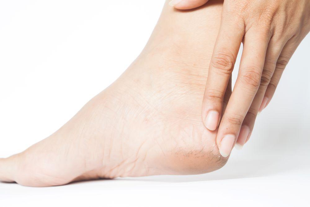 how do i stop my heels from cracking